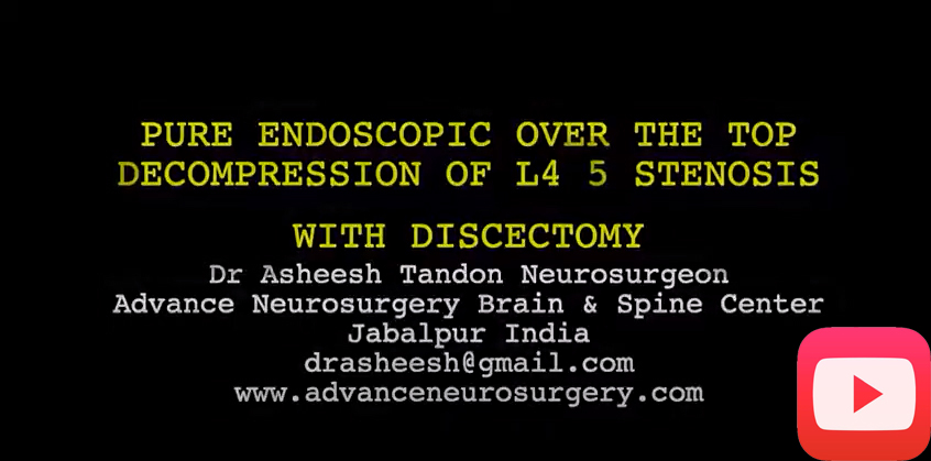 Neurosurgery India-Dr.Asheesh Tandon